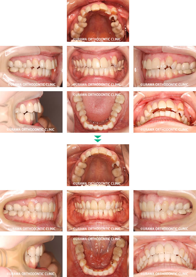 上顎前突の症例1