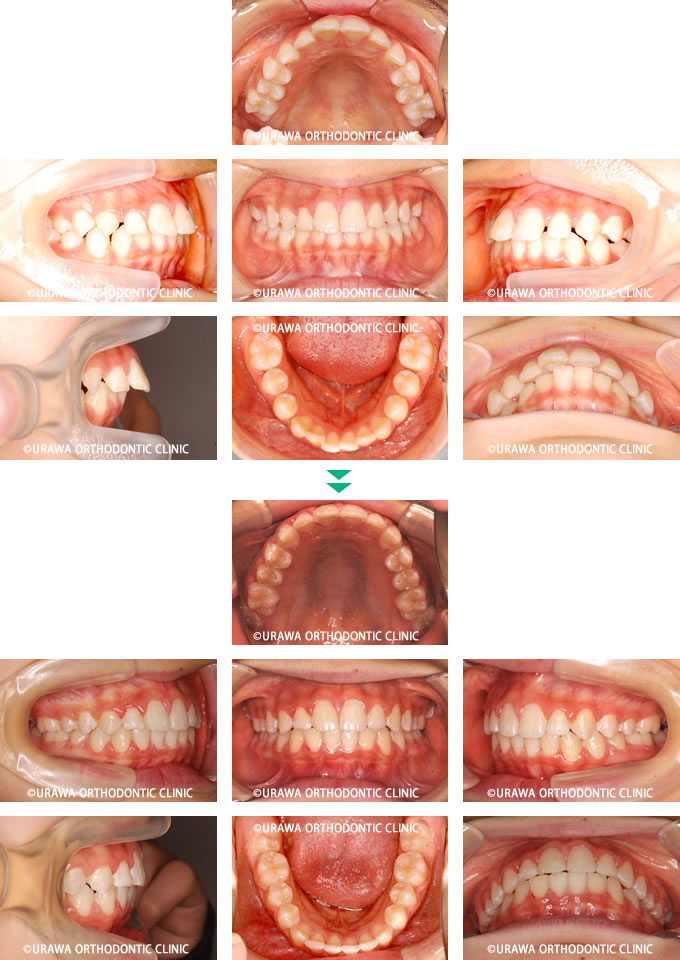 子供の上顎前突の症例