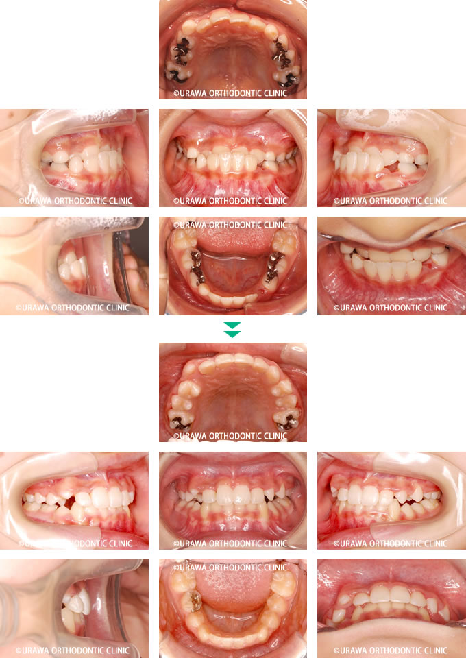 下顎前突の症例1