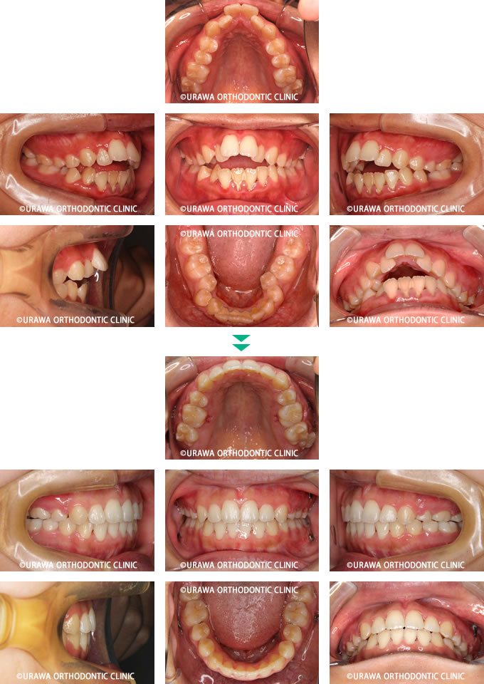 開咬の症例1