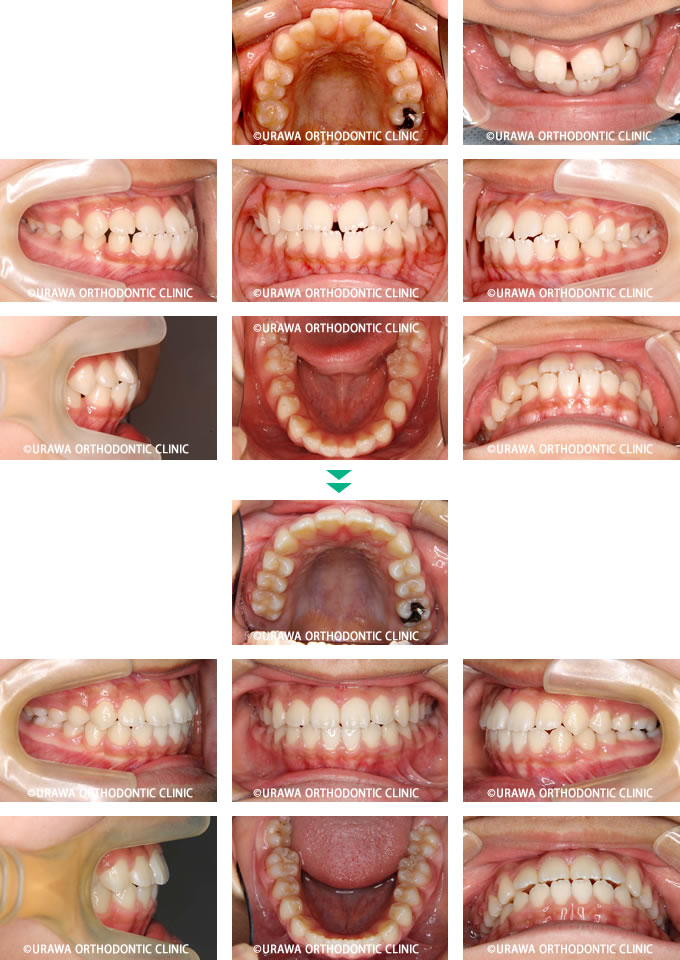 スキッ歯の症例1