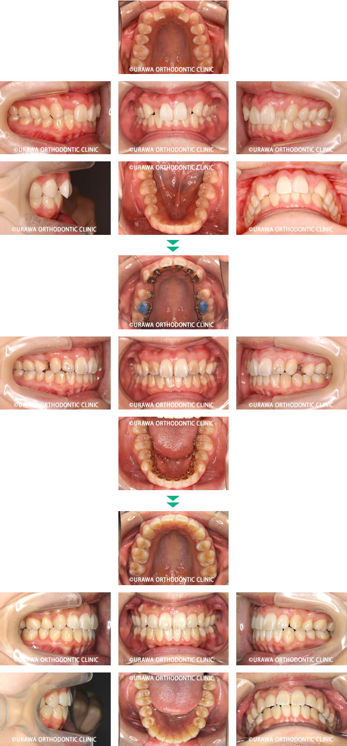 裏側矯正による叢生の症例