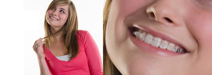 デイモンクリアとクリッピーc 埼玉県さいたま市浦和区の矯正歯科 デーモンシステム Spサイト