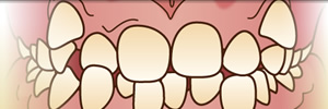 歯並びの状態（症状別）